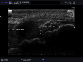 Ultrazvok kolena - kalcinacije v patelarnem ligamentu, indikacija za ESWT 3